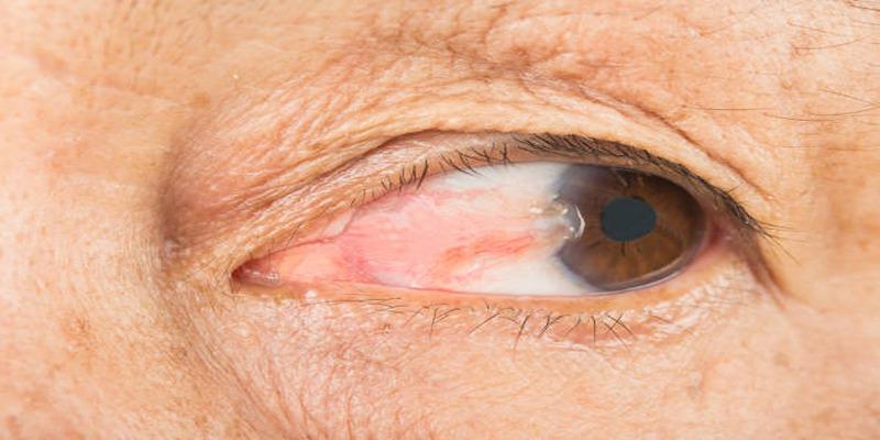 8 Ways to Protect Yourself From Surfer’s Eye (Pterygium)